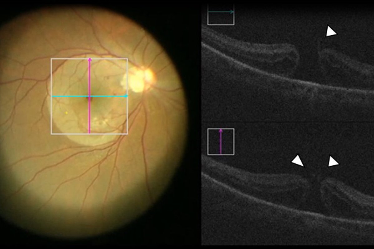Retiro de membrana macular